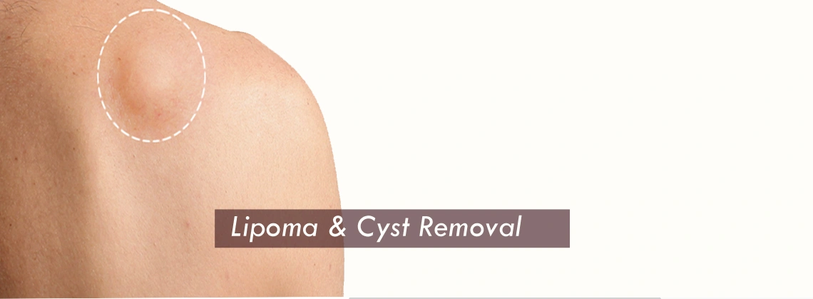 Lipoma Cyst Removal Surgery Clinic in Gurgaon, India